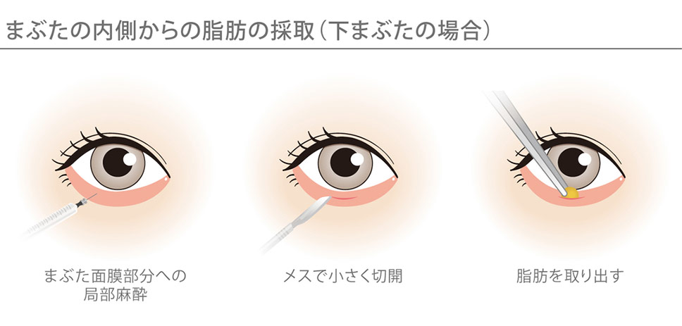 下瞼の裏側(結膜側)から余分な量だけ脂肪自体を丁寧に取り除きます。
